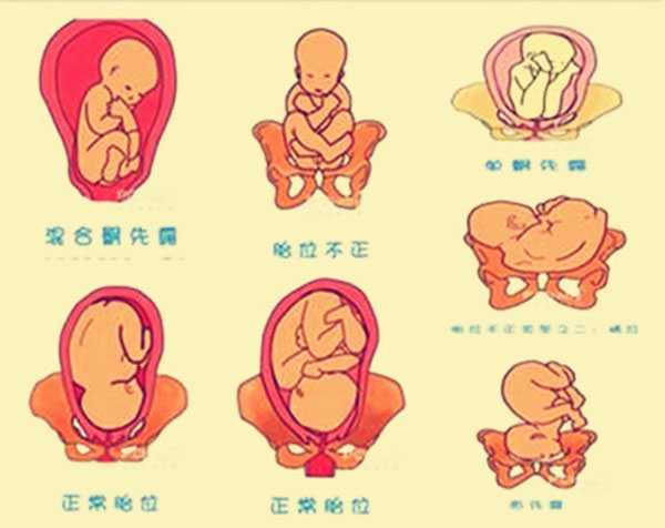 泰国三代试管婴儿步骤_胎位臀位是睡太多的原因吗 胎儿臀位如何纠正能否顺产